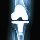 knee replacement surgery germany