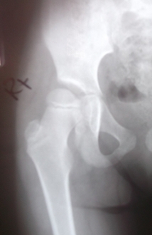 hip replacement surgery germany
