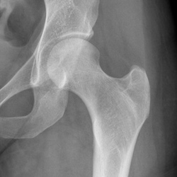 best hospitals for hip surgery in Germany