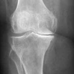 Best hospitals for knee surgery in Germany